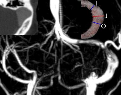 Effects of Different Degrees of Extraluminal Compression on Hemodynamics in a Prominent Transverse-Sigmoid Sinus Junction